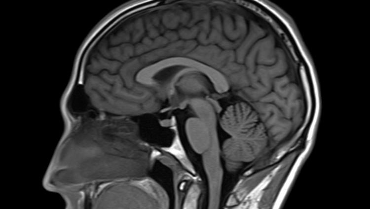 MRI
